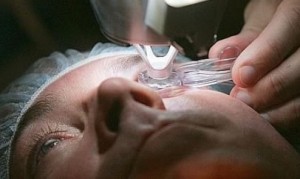 Lasik surgery