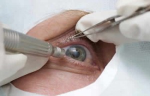 secondary cataract